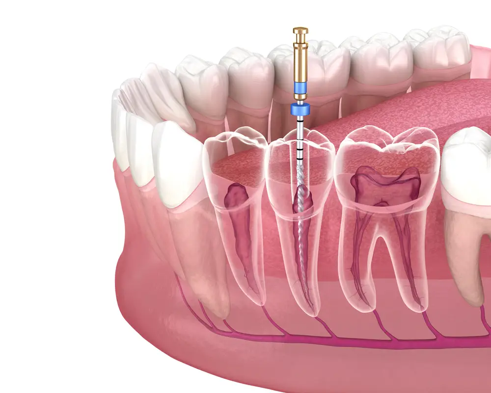 endodoncia